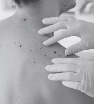 Skin Lesion Removal & Mole Check